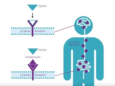 Grafik aus dem Azerta-Webinoon über Opioid-induzierte Obstipation