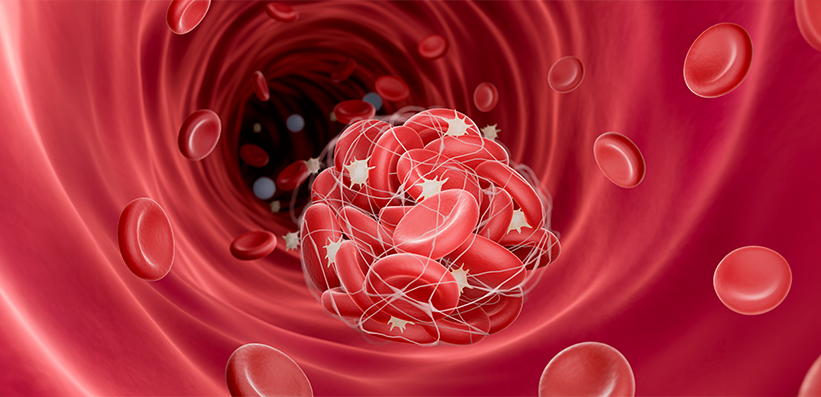 Darstellung eines Blutgerinnsels (Thrombus), Illustration