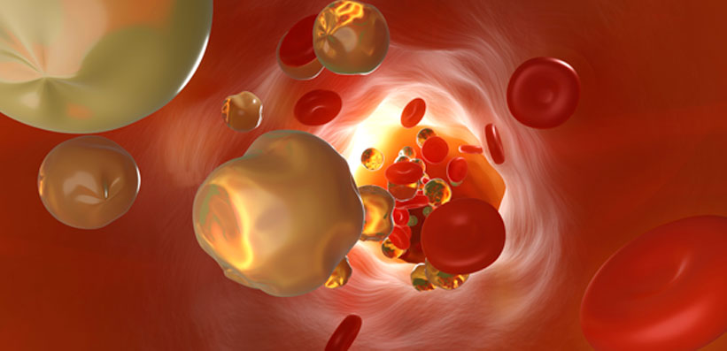 Grafik Arterie durch Cholesterin verstopft