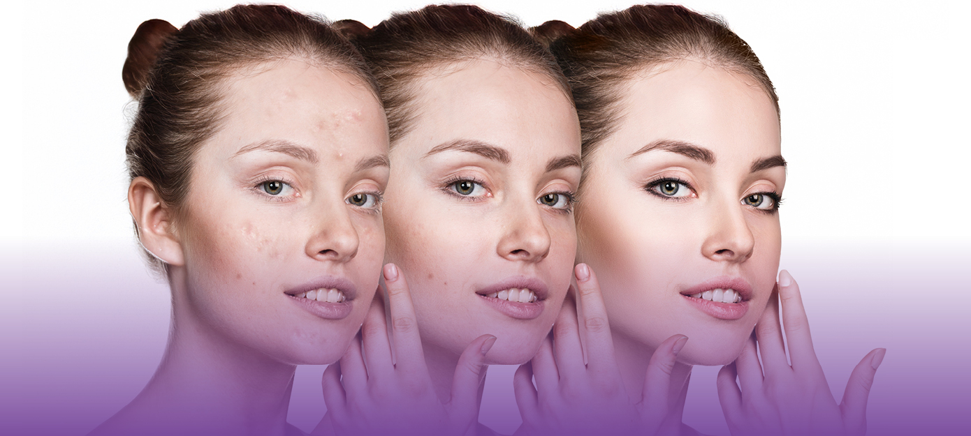 Akne vulgaris – klinische Darstellung und Therapieerfolg, CME zertifizierte Fortbildung für Dermatologen