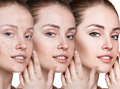 Akne vulgaris – klinische Darstellung und Therapieerfolg, CME zertifizierte Fortbildung für Dermatologen