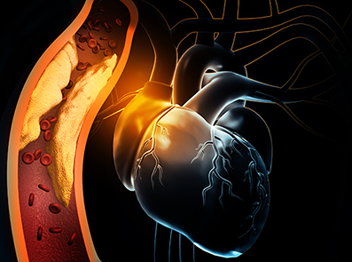 Lipidologie: Menschliches Herz mit verstopften Arterien. 3D-Illustration