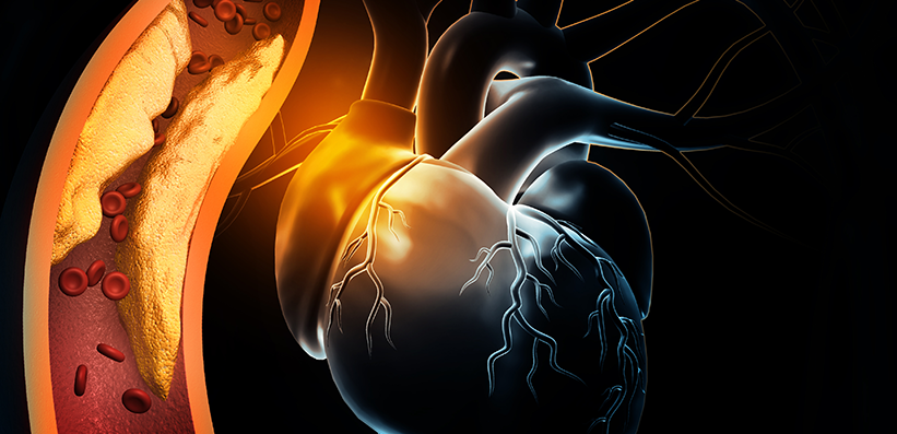 Lipidologie: Menschliches Herz mit verstopften Arterien. 3D-Illustration
