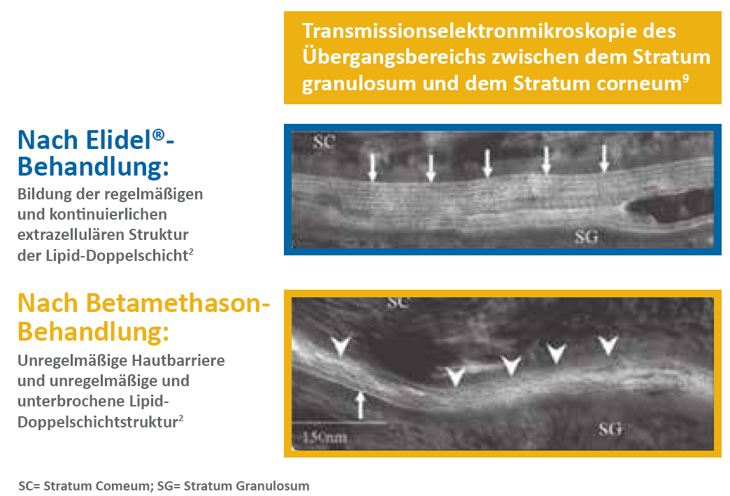 Transmisionselektroskopie der Haut nach Elidel und TCS Behandlung